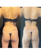 ウィリング(WiLLing)/食事制限なし簡単ヒップアップ！