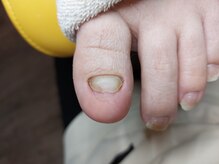 爪切り屋 足楽/肥厚爪★厚く伸びない【after】