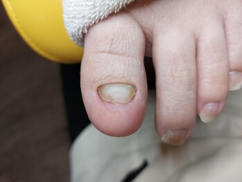 爪切り屋 足楽/肥厚爪★厚く伸びない【after】