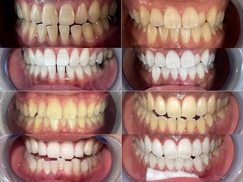 エクシアホワイトニング 札幌中島公園店/Before After［ホワイトニング］