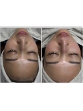 サロン ド ベル(salon de Belle)/産毛形成でお顔にバブみが！