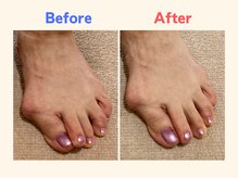 ピース/足指の重なりが気になる60代女性