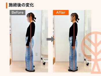 ただき接骨院 整体院 新前橋院/術後の変化：反り腰・猫背