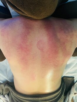 イニティウム 清澄白河(initium)/深部ケア！スライドカッピング