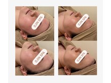 オージン スパ(OJIN SPA)/ララピールは「肌育ピーリング」