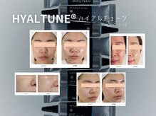 シュリ(Shri)/韓国ツヤ肌は水光ピーリングで☆