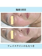 ノト(NOTO)/フェイスラインのもたつき改善