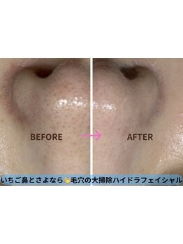 毛穴ケアをしたい