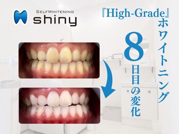 ホワイトニングサロン シャイニー 浜松細島店(shiny)/【超絶・美・白】ホワイトニング