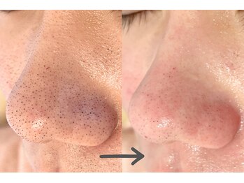 モネ(monet)/韓国式3D毛穴洗浄