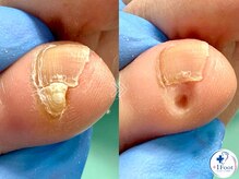 プラスワンフット 本厚木(+1 Foot)/痛い・引っかかる・邪魔な副爪に