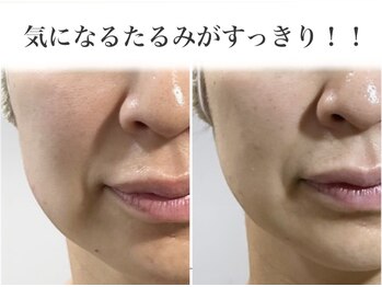 サロンドボーテ ベル(SALONDEBEAUTE BELLE)の写真/気になるほうれい線たるみは脂肪分解/毒流しリンパですっきり◎リフトアップ小顔◎見た目年齢は変えられる