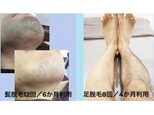 ザ サンラウンジ 長野店(THE SUN LOUNGE)/メンズに人気のヒゲ脱毛！