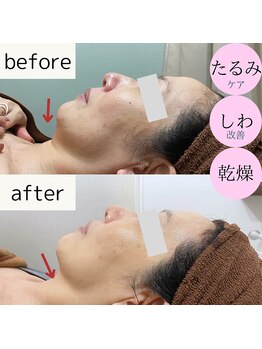 ユーエムスタイル(UMStyle)/超音波リフト★水玉リフティング