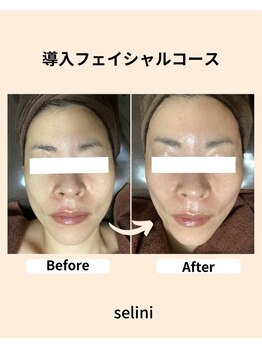 セリーニ(Selini)/一回でこの結果♪