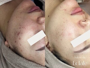 サロンドエクラル(Salon de Eclale wax)/ハーブリプロニキビケア３回施術