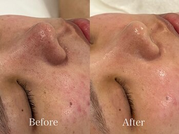 トム(Thom)/艶肌wax+ハーブピーリング1回