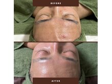 人気No.1☆効果重視のREVI陶肌トリートメント！肌悩みゼロへ◎