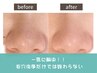 人気No1【毛穴診断付き】韓国式鼻毛穴洗浄×毛穴徹底引き締め！¥2,900