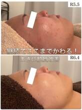 ビジュープラス つくば店(Bijou+)/ハーブ継続で根本肌質改善