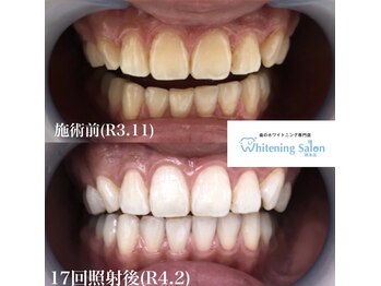 ホワイトニングサロン 熊本店/通いやすいホワイトニング