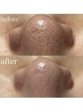 薫風/毛穴洗浄／30代