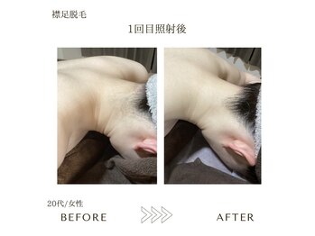 サロン エイトミー(salon 83)/レディース脱毛/before→after