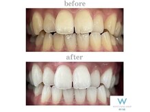 ホワイトニングショップ 山口店/山口ホワイトニング