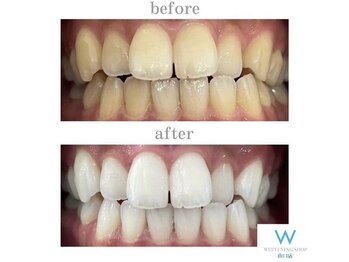 ホワイトニングショップ 山口店/山口ホワイトニング