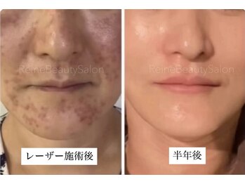 レーヌ(Reine)/白玉ピコジェット＋臍帯原液