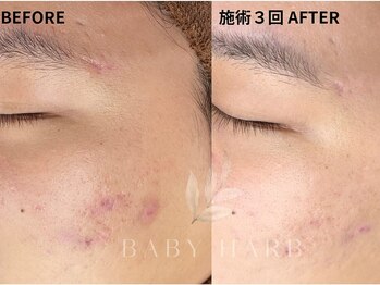 フィズ 戸塚店(FIS)/☆ハーブピーリング☆都度払い