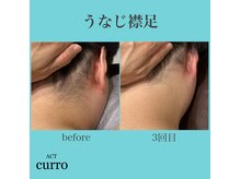 アクト クロ(ACT curro)/【うなじ襟足】脱毛施術例