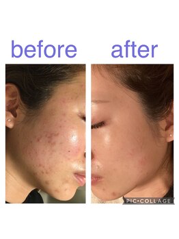 中洲美容鍼灸院 福岡博多院/ビフォーアフター