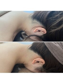 ミース 北九州店/うなじ脱毛◆ビフォーアフター