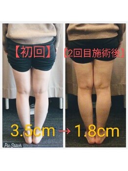 クシロ鍼灸整骨院/【O脚矯正】施術例