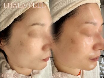 レイネ(REINE)/韓国肌管理★ララピール