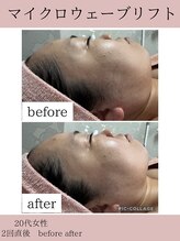 ココ(COCO)/マイクロウェーブリフト/小顔