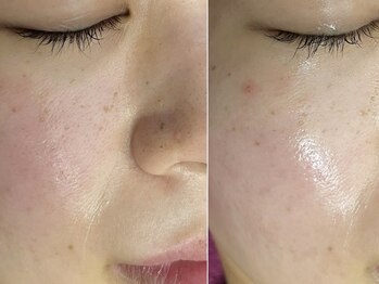 バタフライ 津田沼店(Butterfly)/Butterflyのハーブピーリング!