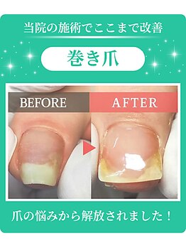 フルフィル 高田馬場店/巻き爪・陥入爪矯正