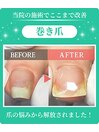 巻き爪・陥入爪矯正