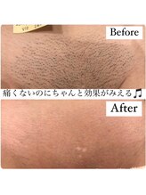 エアリアル 玉名店/VIO脱毛のbeforeafter