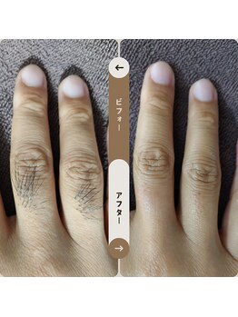 ジュゴン(Dugong)/指の脱毛（Before＆After）