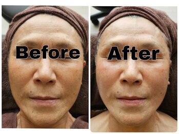 クリスタルビューティー/ハイパーナイフフェイシャル1回