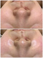 エステティック レイビス 池袋店(RAYVIS)/ツヤツヤ水光肌♪