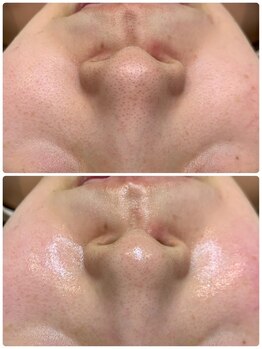 エステティック レイビス 池袋店(RAYVIS)/ツヤツヤ水光肌♪