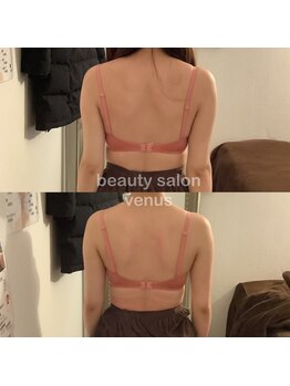 ヴィーナス(Venus)/バストアップで肩甲骨矯正も！