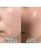 キレナル(KIRENAL)/ホワイトスノーピール