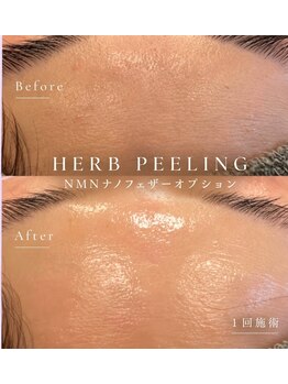 エクラ 戸塚(Eclat)の写真/年齢肌に徹底アプローチ！REVI ハーブピーリングでハリ艶あふれる若々しい印象へ♪