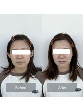 セメ(S’aimer)/磁気パックで1トーン以上美白☆