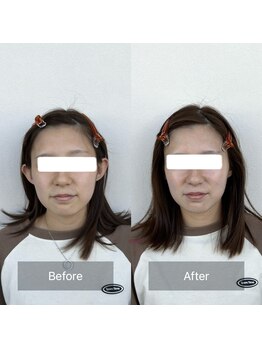 セメ(S’aimer)/磁気パックで1トーン以上美白☆